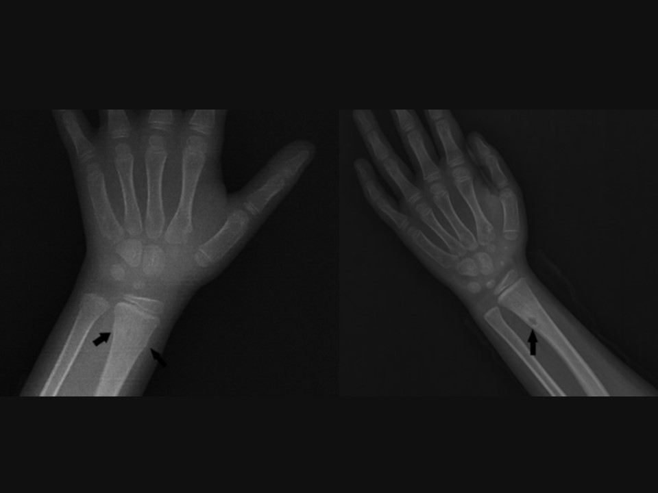 A torus fracture of the distal radius and a wellcircumscribed radiolucent lesion in the cortex of distal radius at the former fracture site.