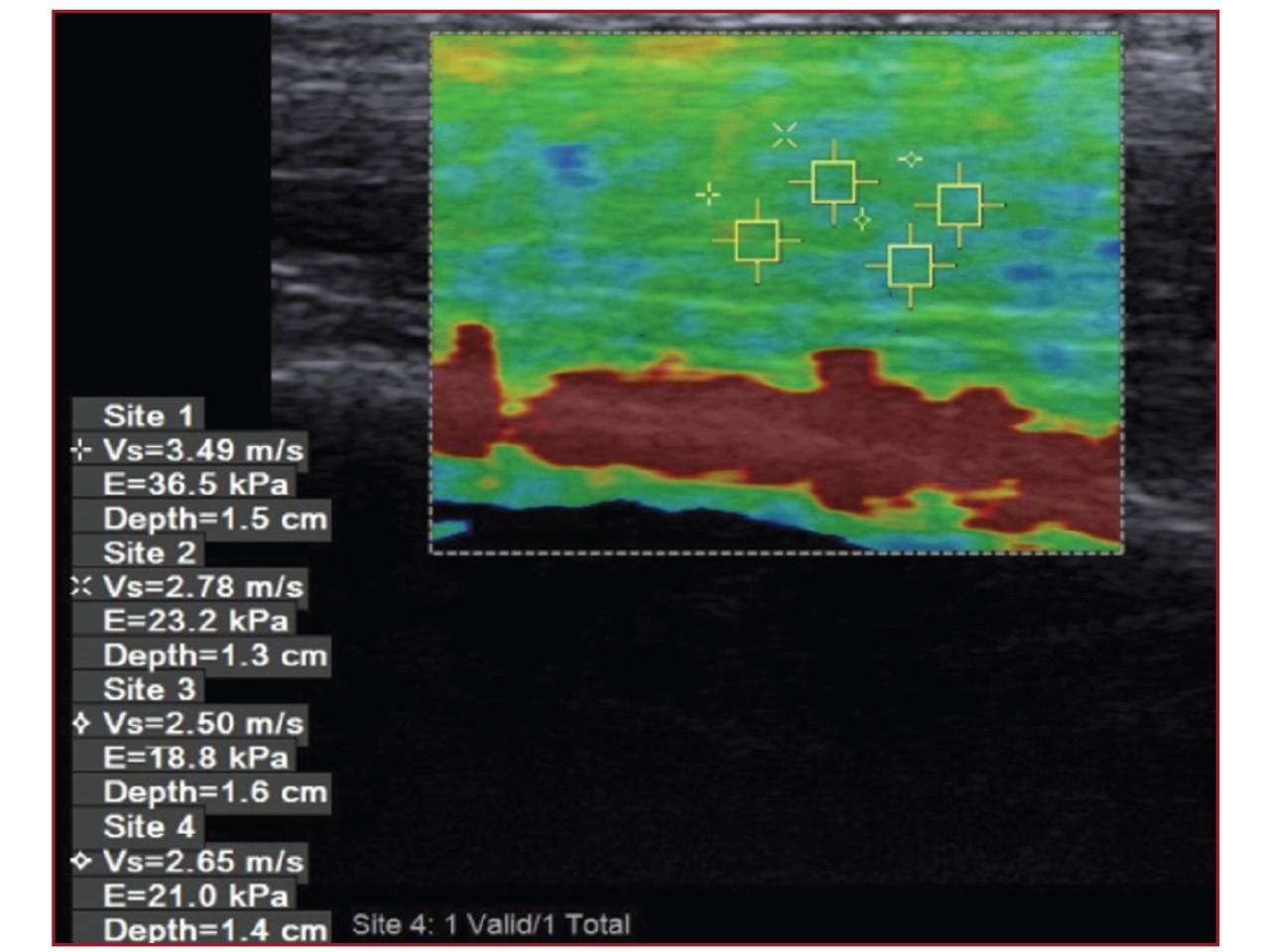 VTIQ measurements of MTJ of Achilles tendon in a 14 years old healthy boy