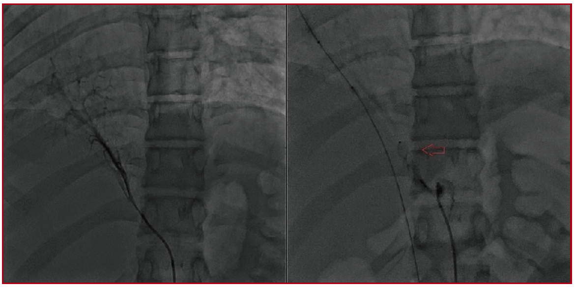 Figure 1: The artery-supplying accessory lobe was occluded with a 6×4 ADO-II device in Scimitar Syndrome.