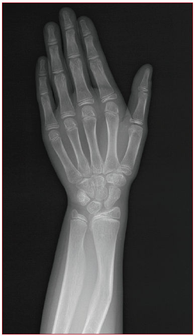 Madelung deformity detected on left wrist radiograph: radial bowing, premature fusion of the distal radial epiphysis